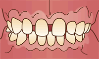 空隙歯列